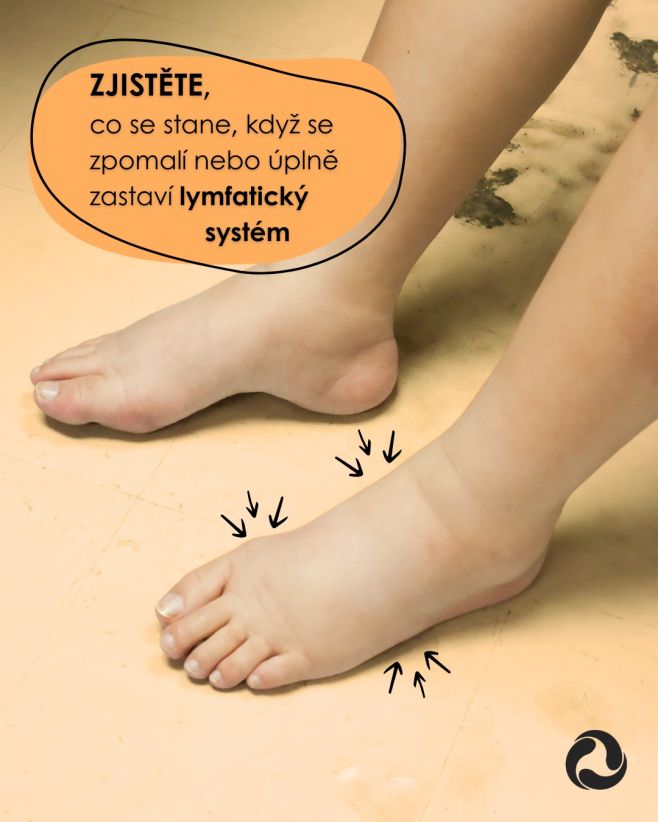 🆘 Co se stane, když se zpomalí nebo úplně zastaví lymfatický systém? 💧 Tělo začne velmi hlasitě protestovat, protože lymfa...
